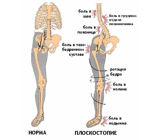 Апофизит пяточной кости у ребенка причины симптомы и лечение