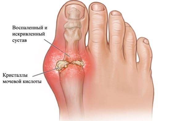 Артрит ног фото