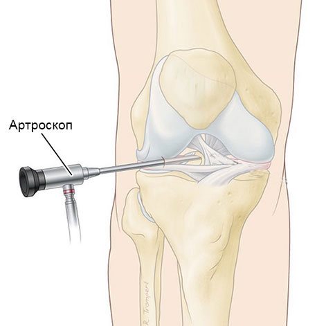 артроскопия коленного сустава