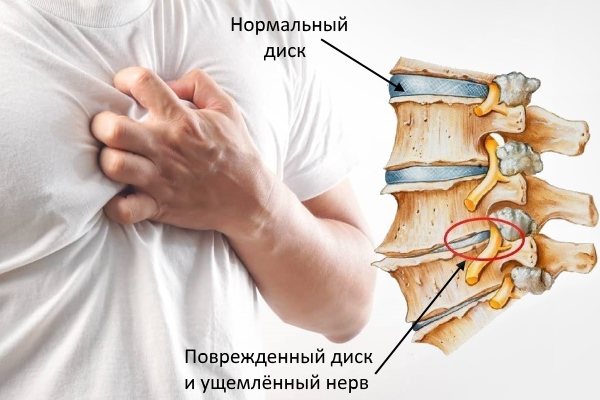 Боли в области сердца при грудном хондрозе