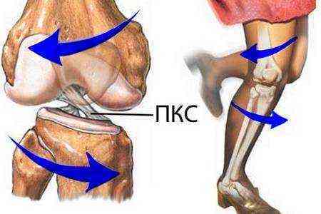 частичный разрыв передней крестообразной связки