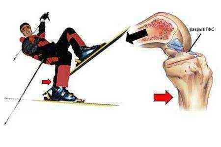 частичный разрыв передней крестообразной связки