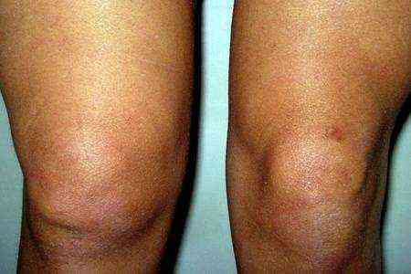 частичный разрыв передней крестообразной связки