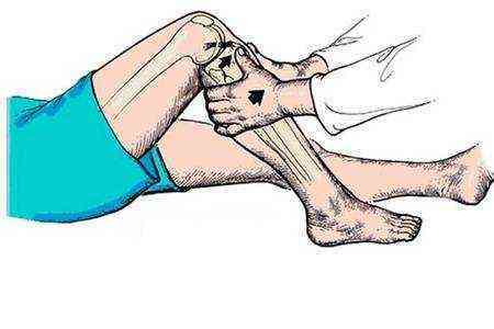 частичный разрыв передней крестообразной связки