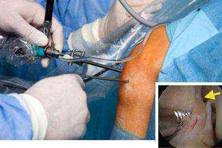 частичный разрыв передней крестообразной связки