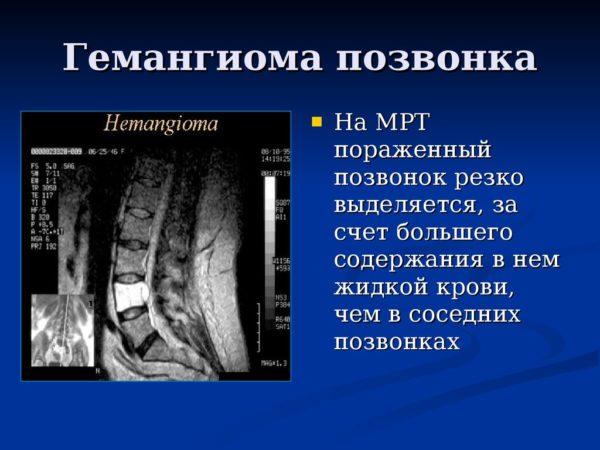 Что такое гемангиолипома позвонка и как её лечить