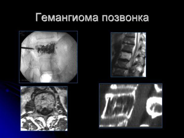 Что такое гемангиолипома позвонка и как её лечить