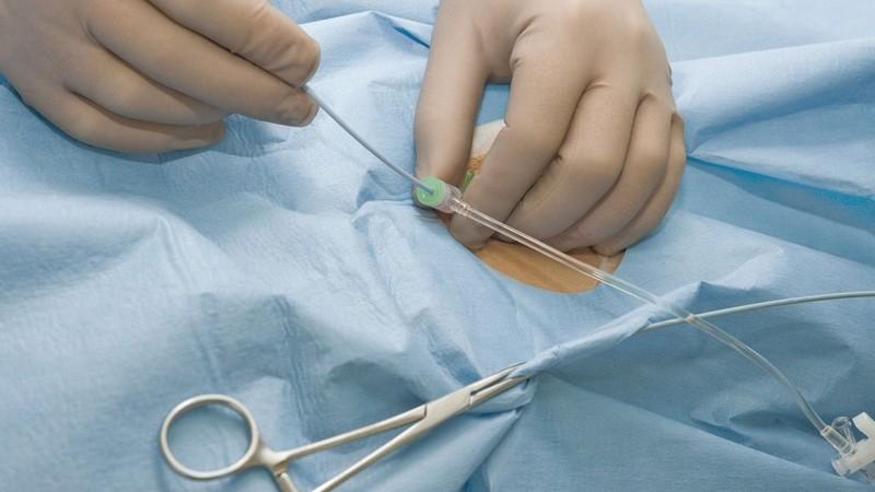 Что такое гемангиолипома позвонка и как её лечить