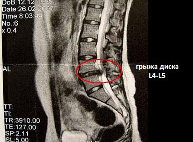 Диск l4l5 отделяет 4 и 5 позвонок поясничного отдела (он обозначается латинской буквой l)