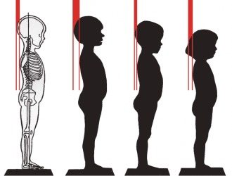 Для профилактики кифоза необходимо следить за осанкой