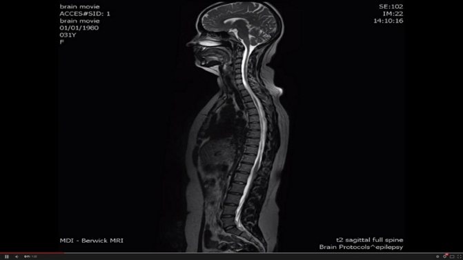 Эффективность эндоскопического удаления грыжи позвоночника