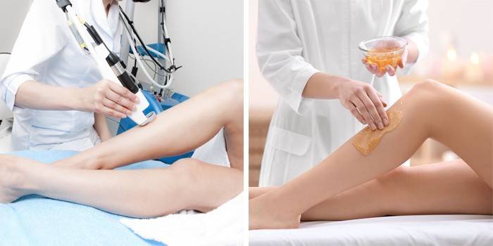 Эпиляция лазером и воском