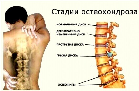 Этапы остеохондроза