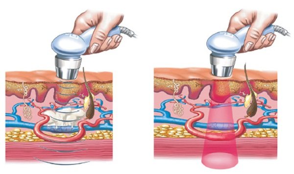 Фонофорез лица с гидрокортизоном, карипаином, гиалуроновой кислотой. Показания и противопоказания, аппараты для ультразвуковой процедуры