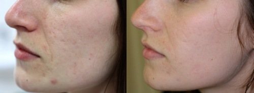 Фото {amp}quot;до{amp}quot; и {amp}quot;после{amp}quot; применения Бадяги