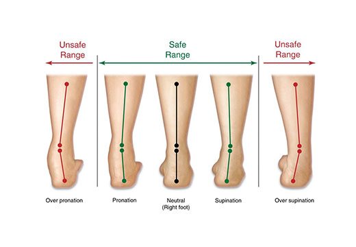 гипопронация стопы лечение