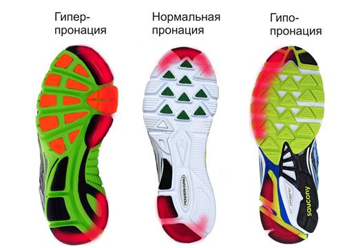 гипопронация стопы лечение