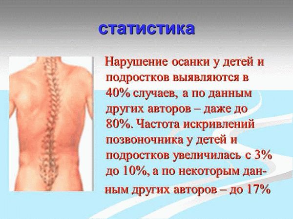 Грудной кифоз возникает у ребенка в возрасте __ мес.