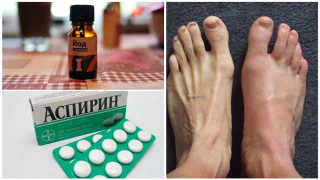 Хороший клинический эффект в борьбе с проявлениями подагры проявляет йод с аспирином