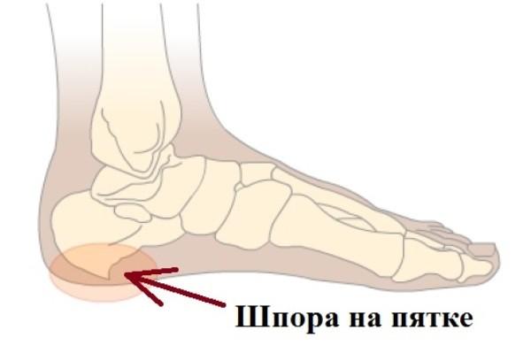 Избавляемся от пяточной шпоры