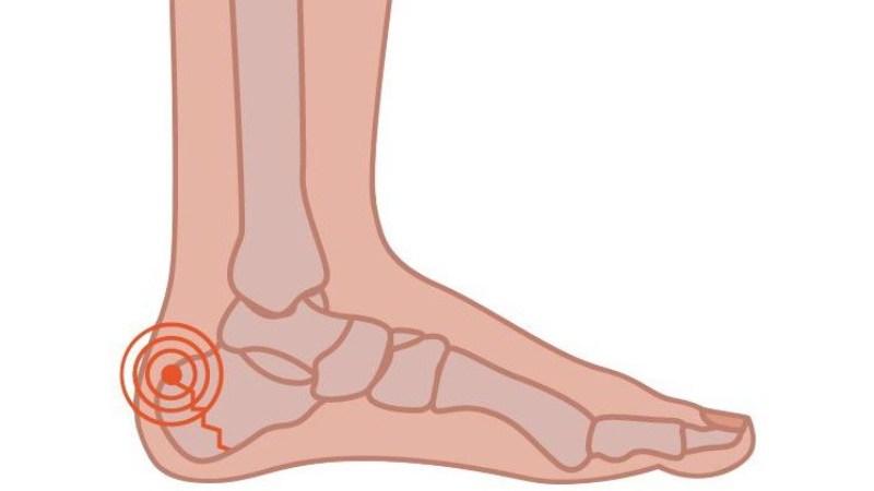 Как лечить апофизит пяточной кости