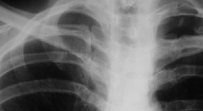 Как лечить трещину ребра в домашних условиях