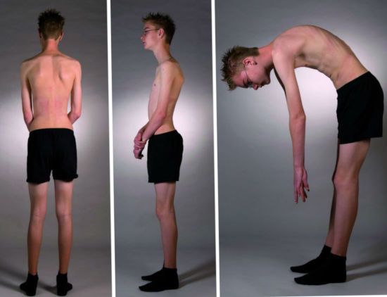 Кифоз у подростков