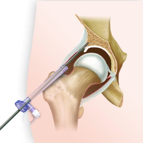 Киста мягких тканей бедра