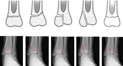 классификация перелома