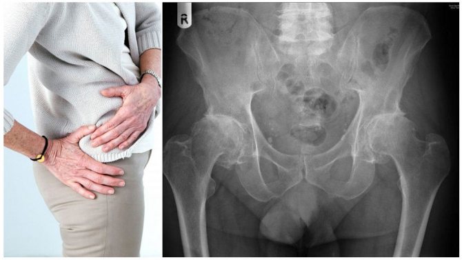 Коксартроз тазобедренного сустава