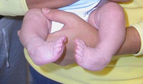 Косолапость