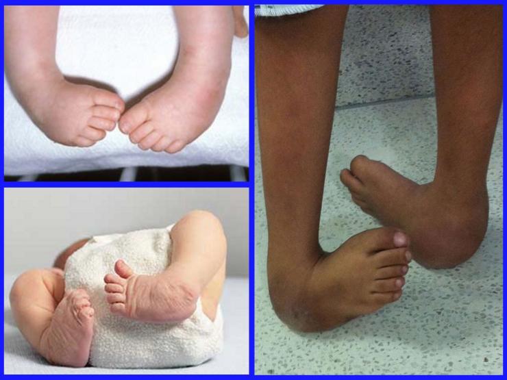 Лечение эквиноварусной деформации стоп