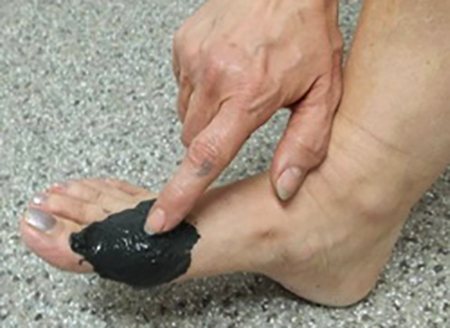 Лечение грязями