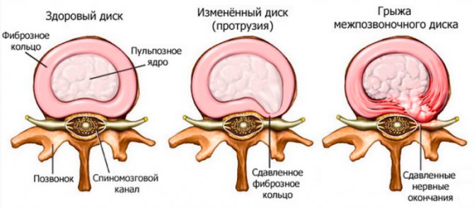 Лечение позвоночника по методу бубновского