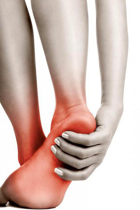 Лечение пяточной шпоры йодом