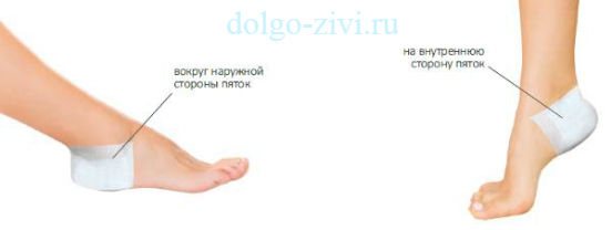 лечение шпор пластырем