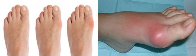 Лечение суставовКто лечит подагру из врачей