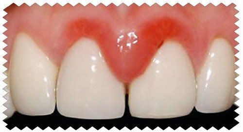 Лечение воспаления суставов пальцев рук причины, статистика, медикаменты и процедуры