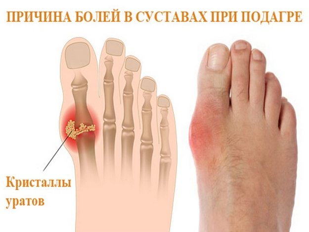 Лекарство от подагры: таблетки, мази, уколы, список препаратов