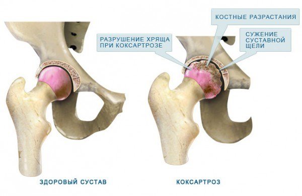 ЛФК при коксартрозе тазобедренного сустава: когда можно обойтись без операции