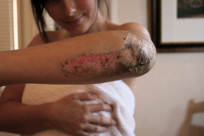 Лфк при переломе локтевого сустава комплекс упражнений