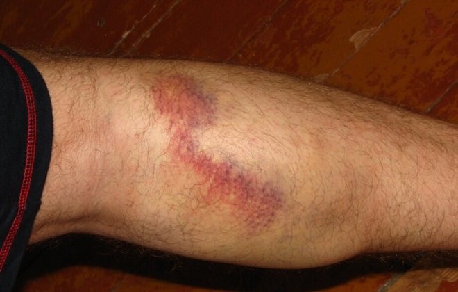 Лопнул сосуд под коленом последствия