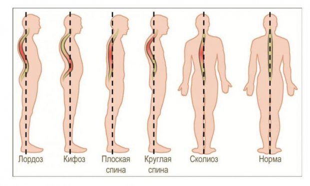 Массаж при кифозе