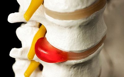 Межпозвоночная грыжа