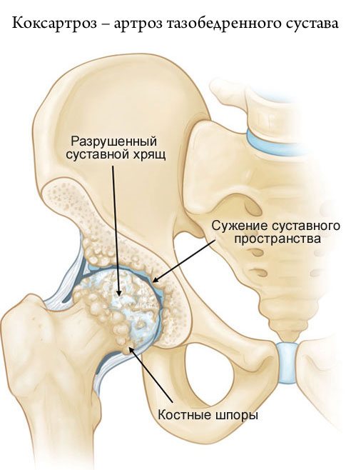 Можно ли при коксартрозе заниматься скандинавской ходьбой?