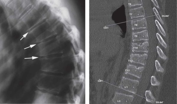 На рентгеновских снимках отчетливо просматривается клиновидная форма позвонков и степень искривления