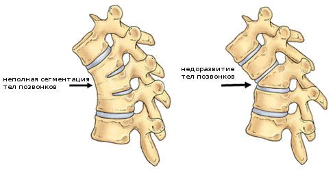 Недоразвитые тела позвоночника