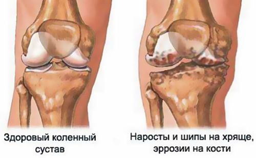 Нормальный и пораженный сустав