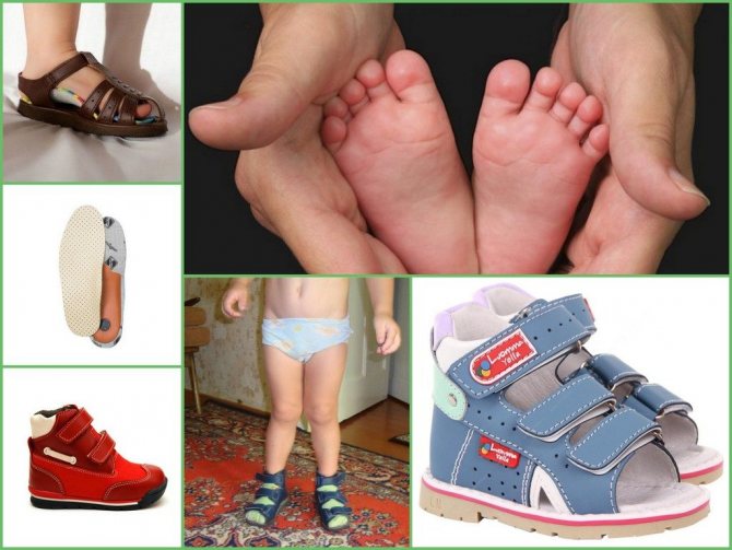 Ортопедическая обувь для детей при вальгусной деформации