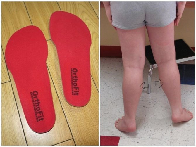 Ортопедические стельки при вальгусной деформации